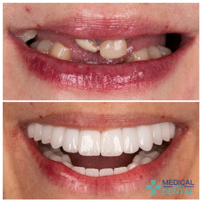 dental implants Turkey