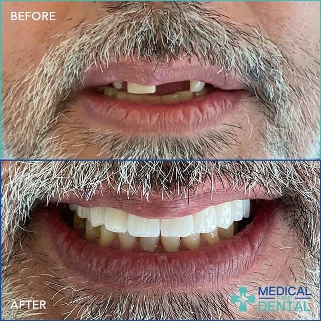 dental treatment in Turkey- all on 4 dental implant treatment