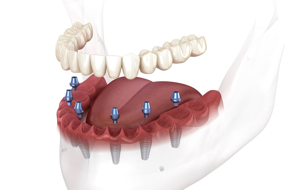 All On 6 Dental Implants All On 6 Dental Implants Antalya,Turkey Prices