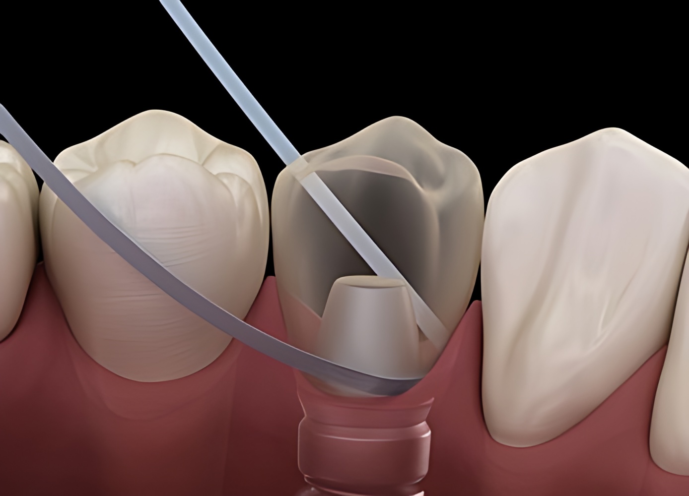 All On 6 Dental Cleaning All On 6 Dental Implant Cleaning Antalya,Turkey