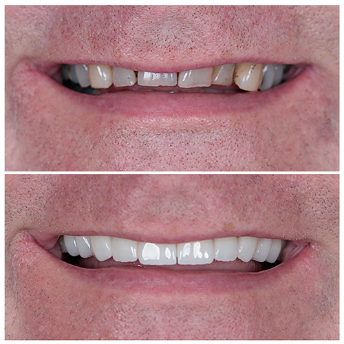 Emax Empress VeneerS Empress Veneers Before After and nice smile in Antalya Turkey