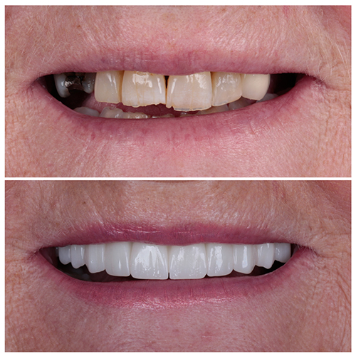 E-Max Crowns in Antalya,Turkey