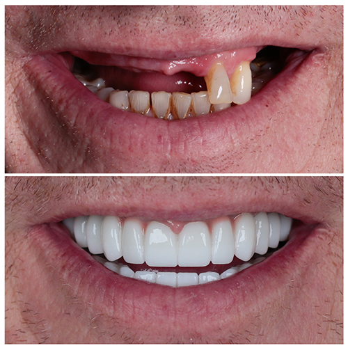 porcelain veneers before after image Turkey