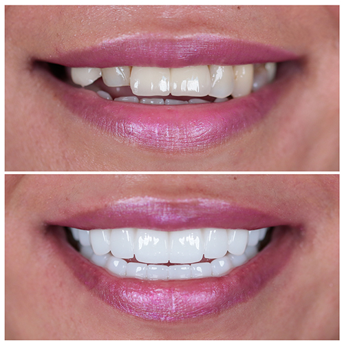 all on 6 dental implants treatment procedures
