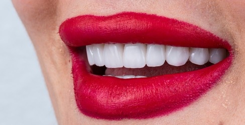 Emax Emprees Veneers Benefits Of Emax Empress Veneers in Antalya Turkey