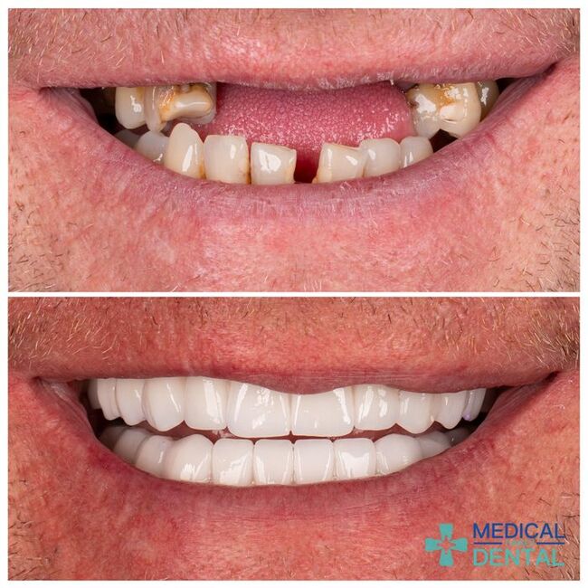 dental implants Turkey