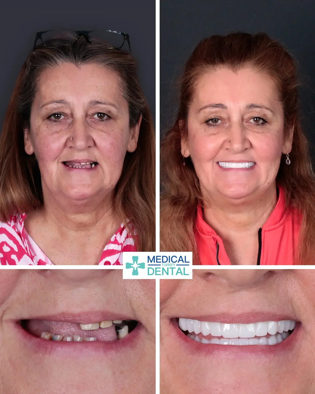 Dental implant before after Dental implant before after