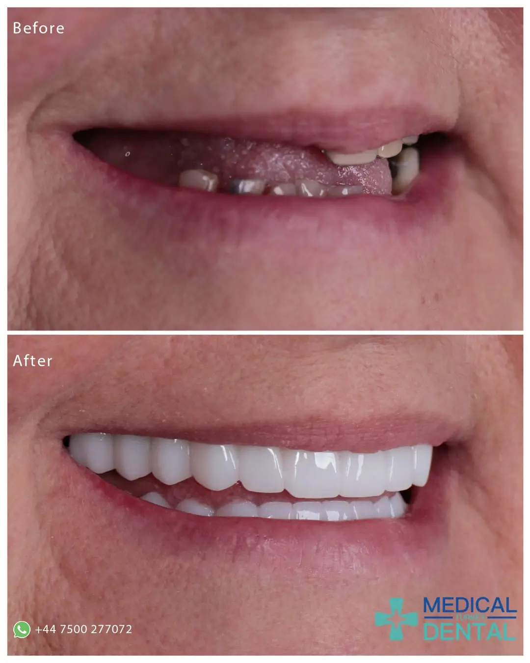 Dental implant before after Dental implant before after antalya turkey