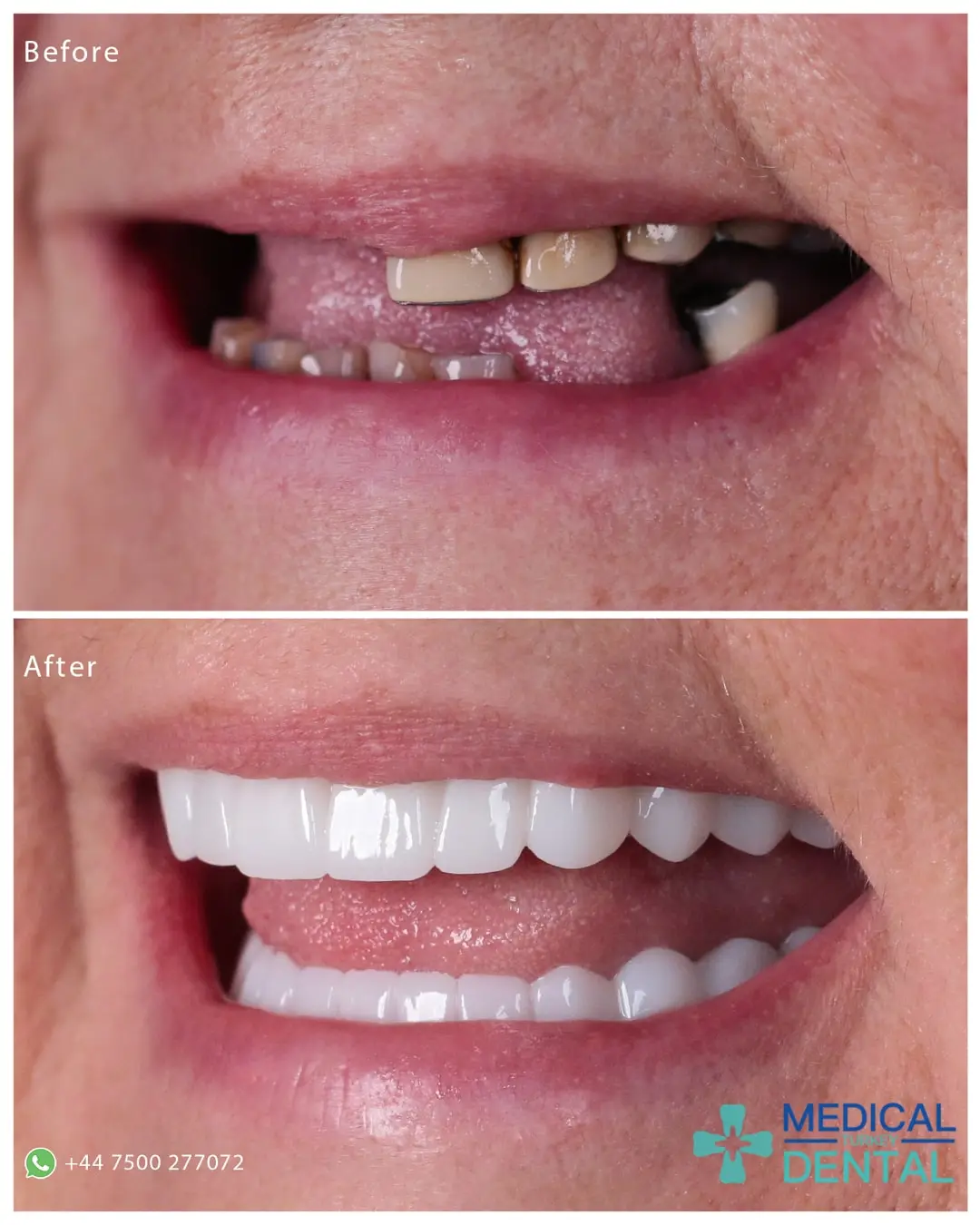 Dental implant before after Dental implant before after