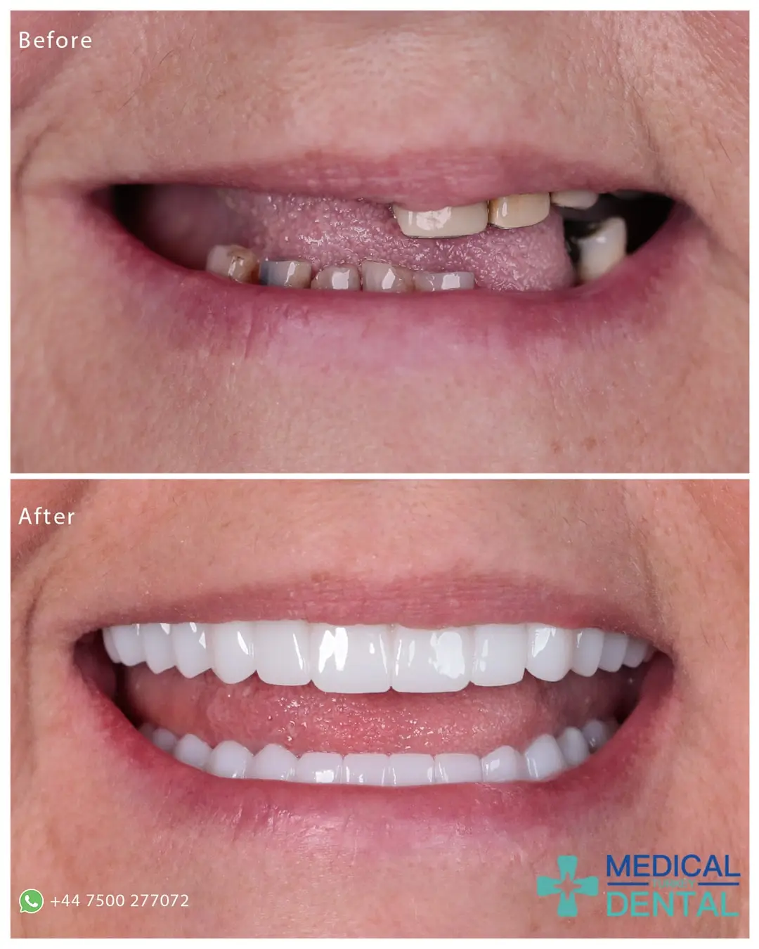 Dental implant before after Dental implant before after