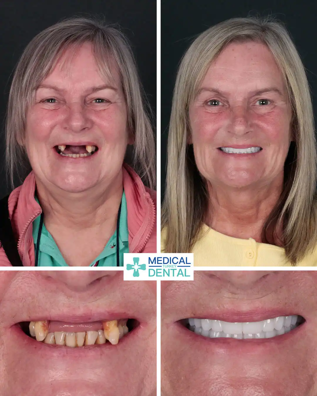 Tooth implant before after Dental implant before after