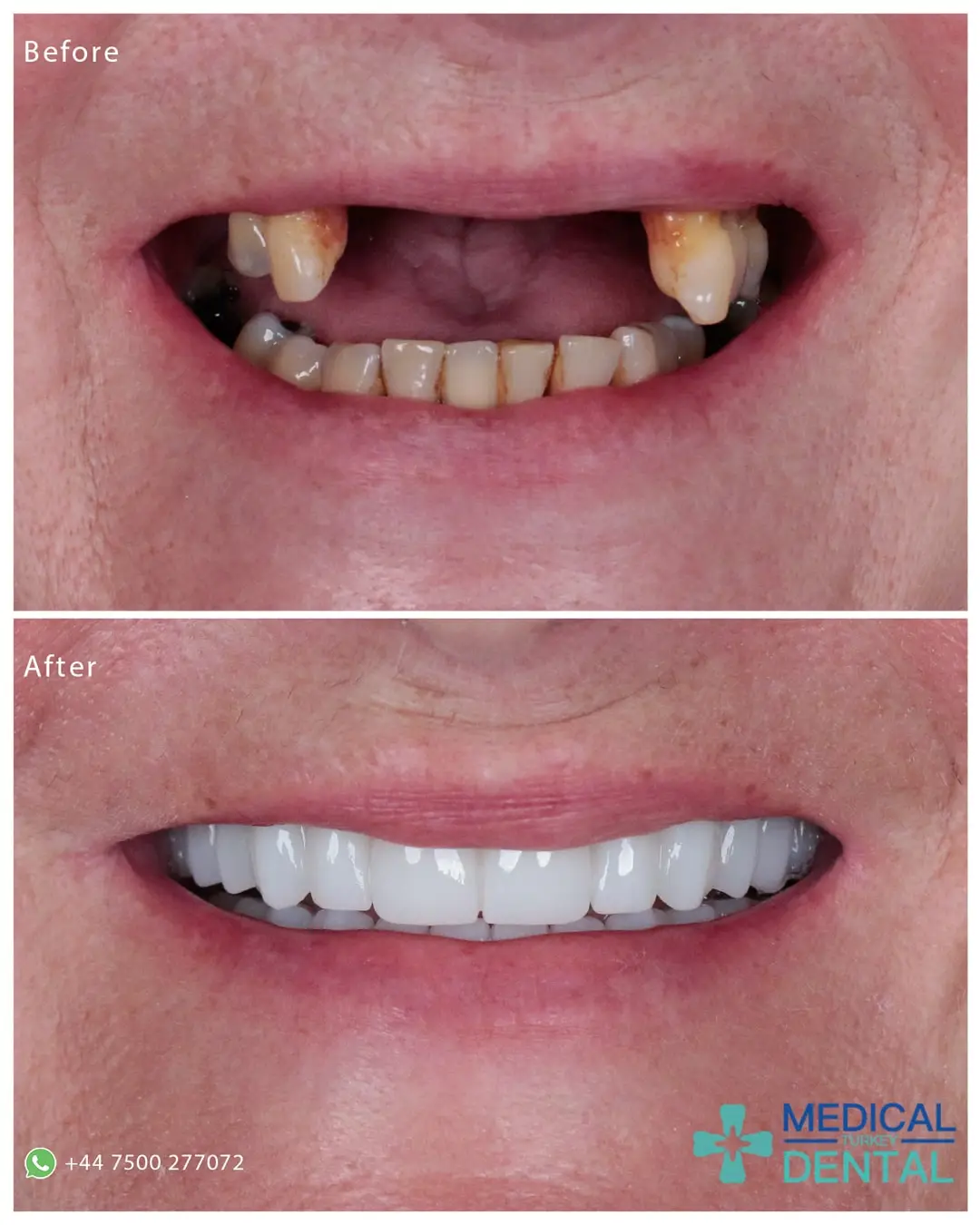 Tooth implant before after Empress veneers-porcelain veneers