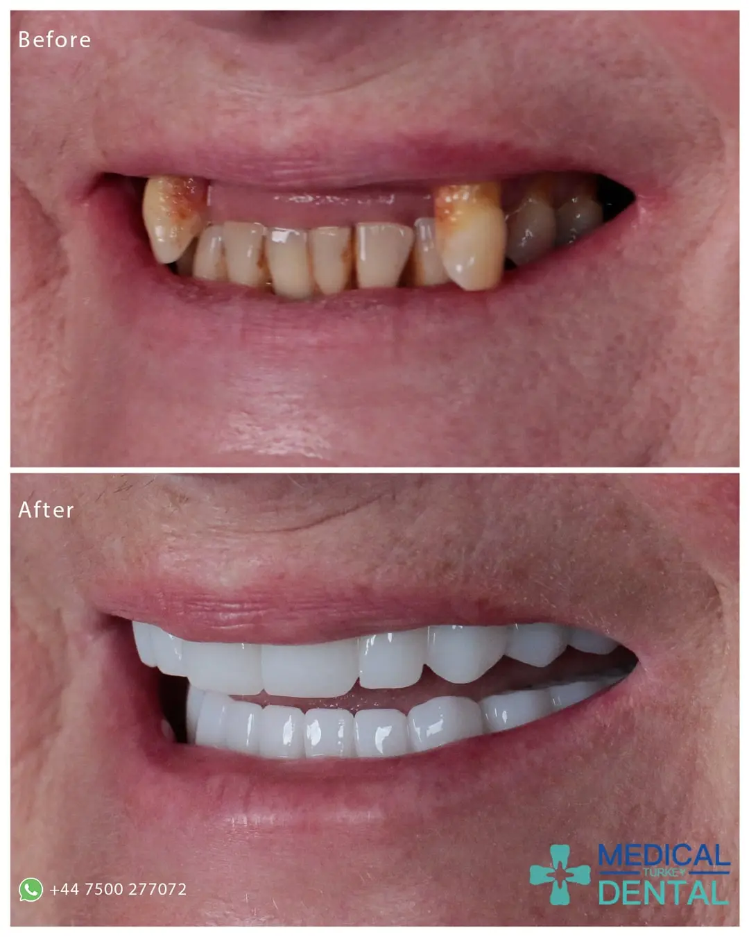 Tooth implant before after Tooth implant before after antalya turkey