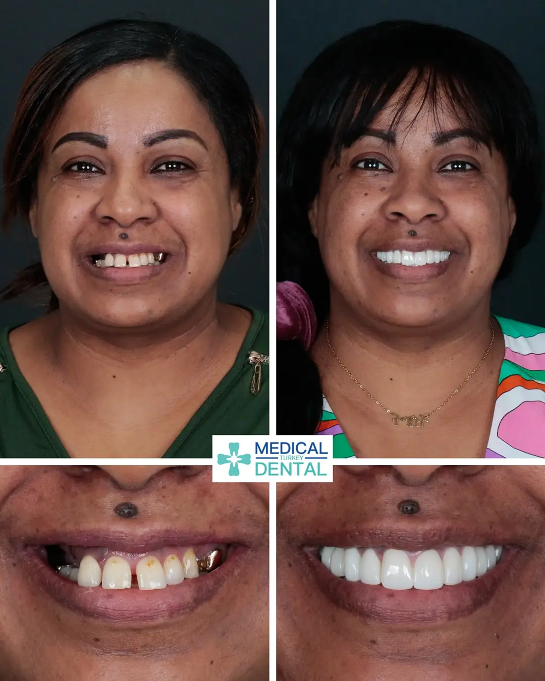 Dental implant before after Tooth implant before after antalya turkey