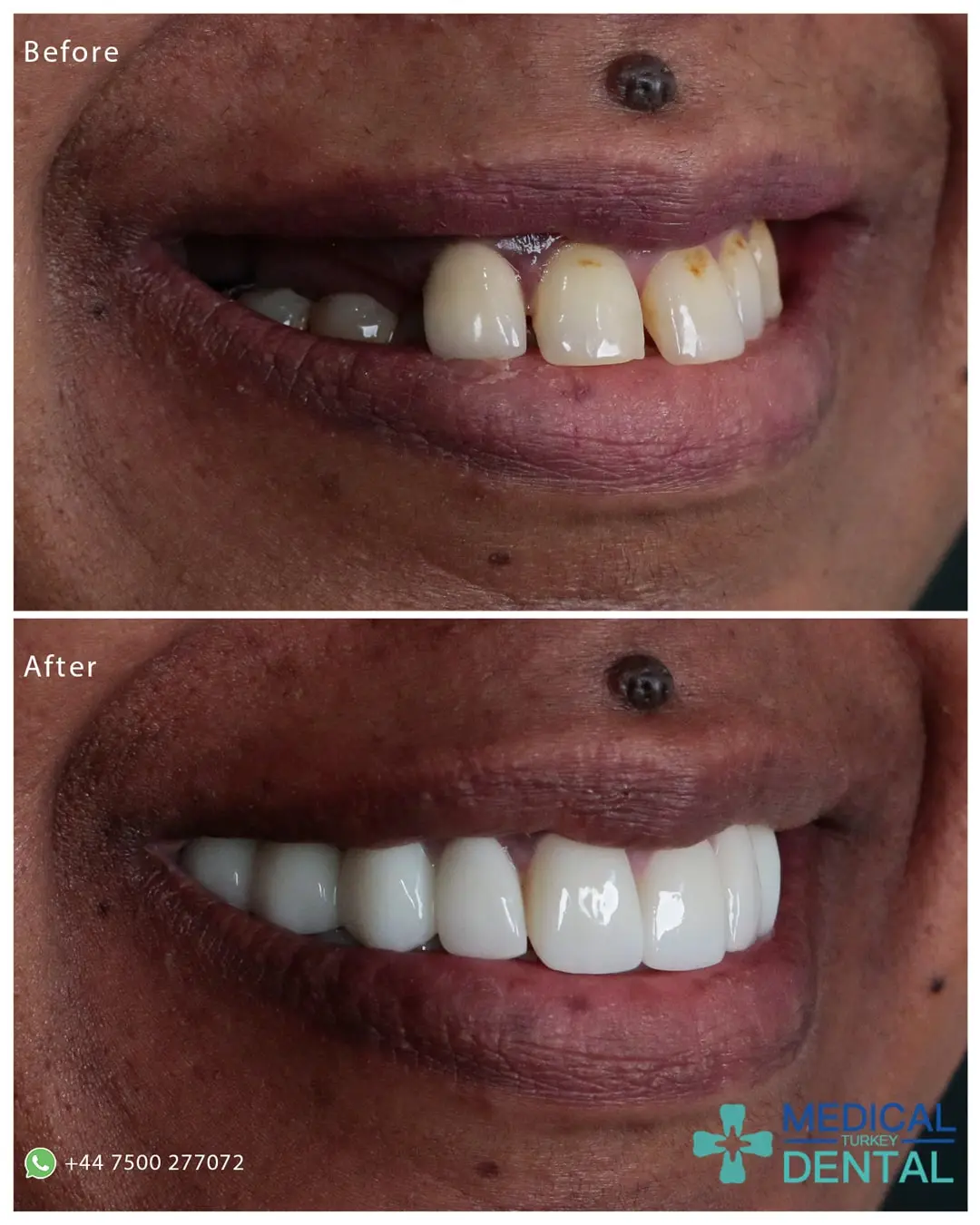 Dental implant before after Tooth implant before after antalya turkey