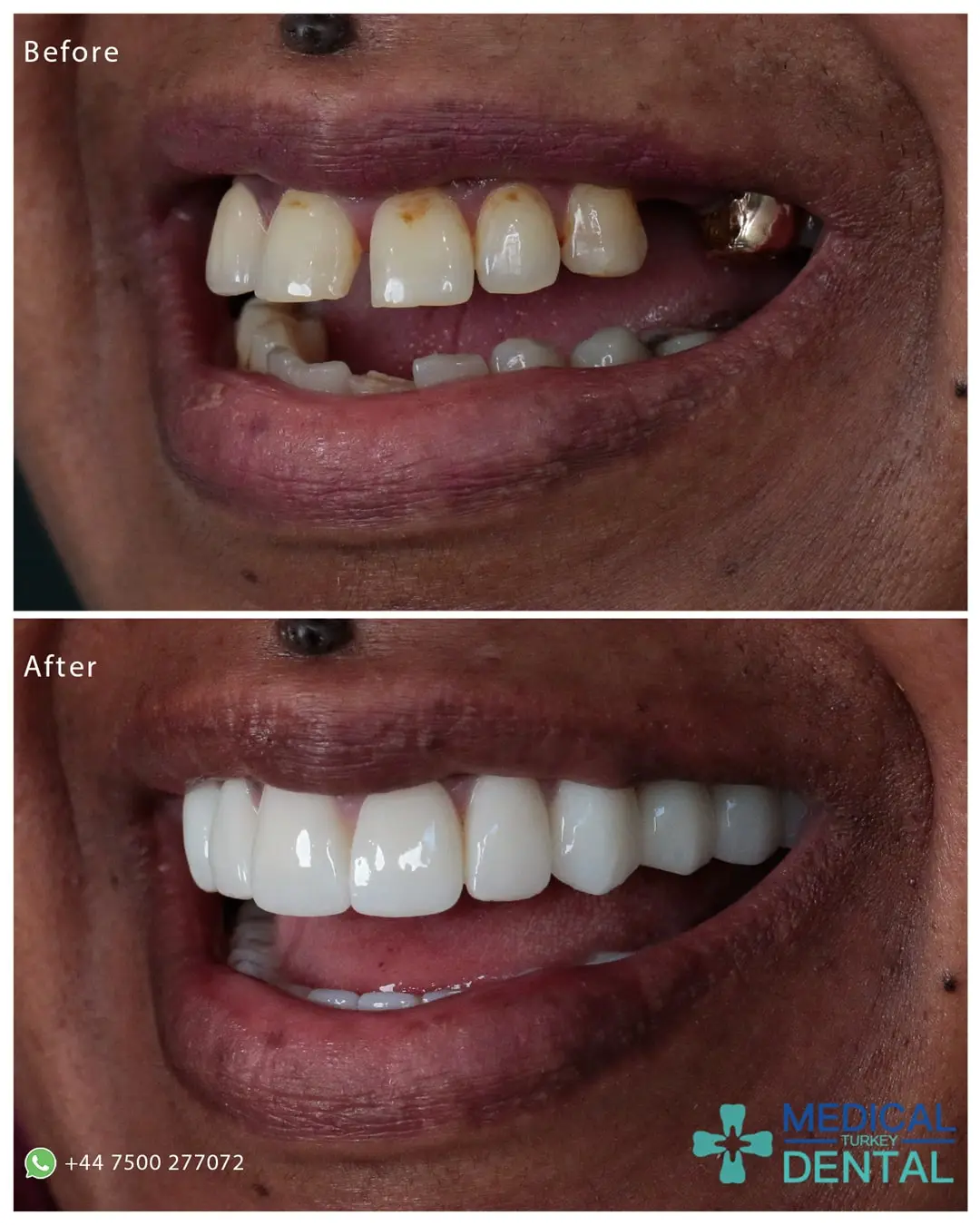 Dental implant before after Tooth implant before after antalya turkey