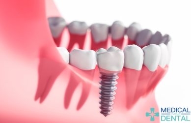 Can tooth implant last forever? Can tooth implant last forever? Dental Clinic Antalya, Turkey
