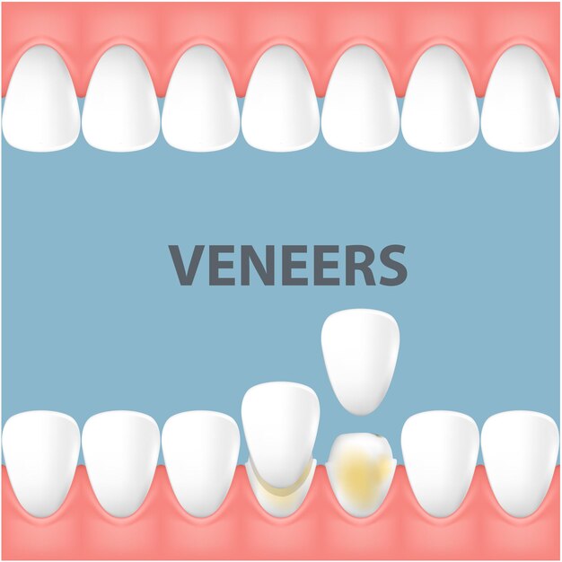 Veneers vs. Crowns What is the difference between veneer & crown? Dentistry Turkey