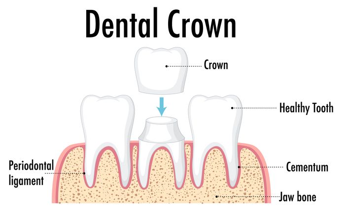 E-Max Crowns in Antalya,Turkey