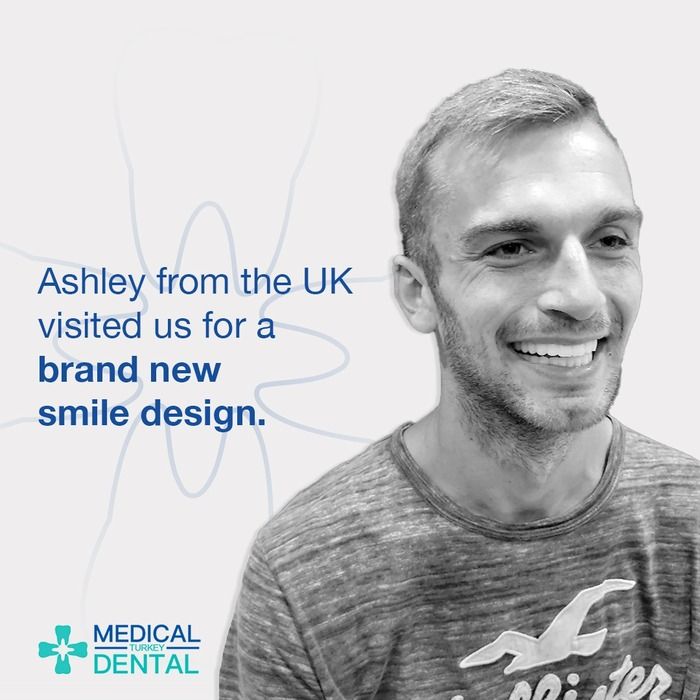 Emax empress veneers Ashley from UK had an empress veneers treatment in Turkey