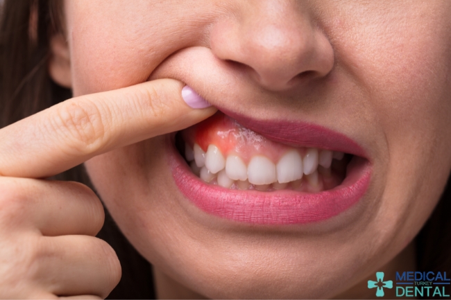 Gum swelling treatment Gum swelling treatment Antalya, Turkey