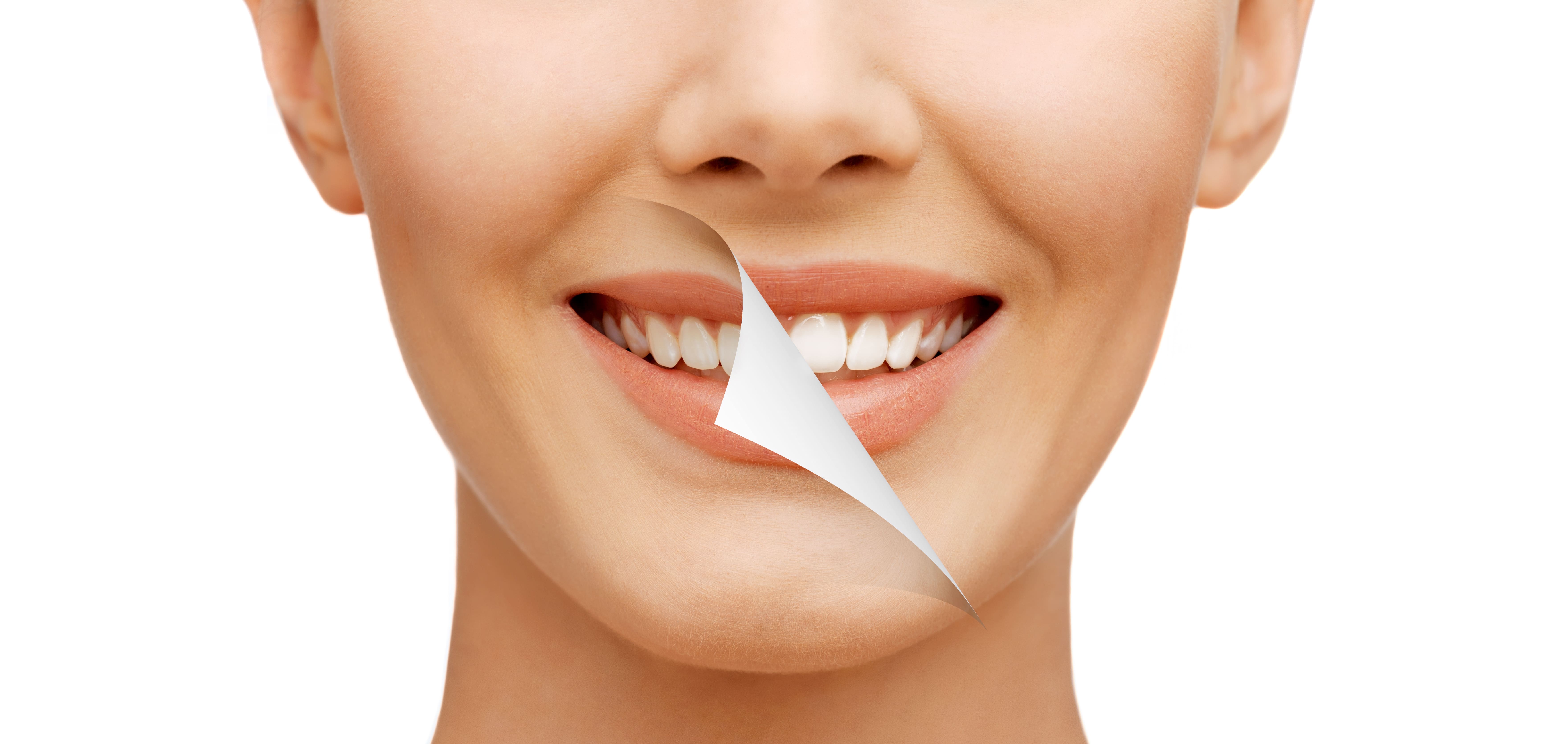 Hollywood Smile (Smile Makeover) Hollywood Smile (Smile Makeover) Dental clinic Antalya