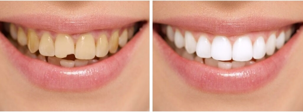 Hollywood Smile (Smile Makeover) Hollywood Smile (Smile Makeover) Dental clinic Antalya