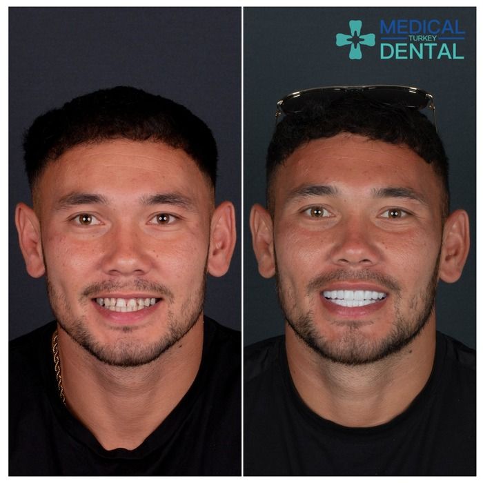 hollywood Smile befora after image