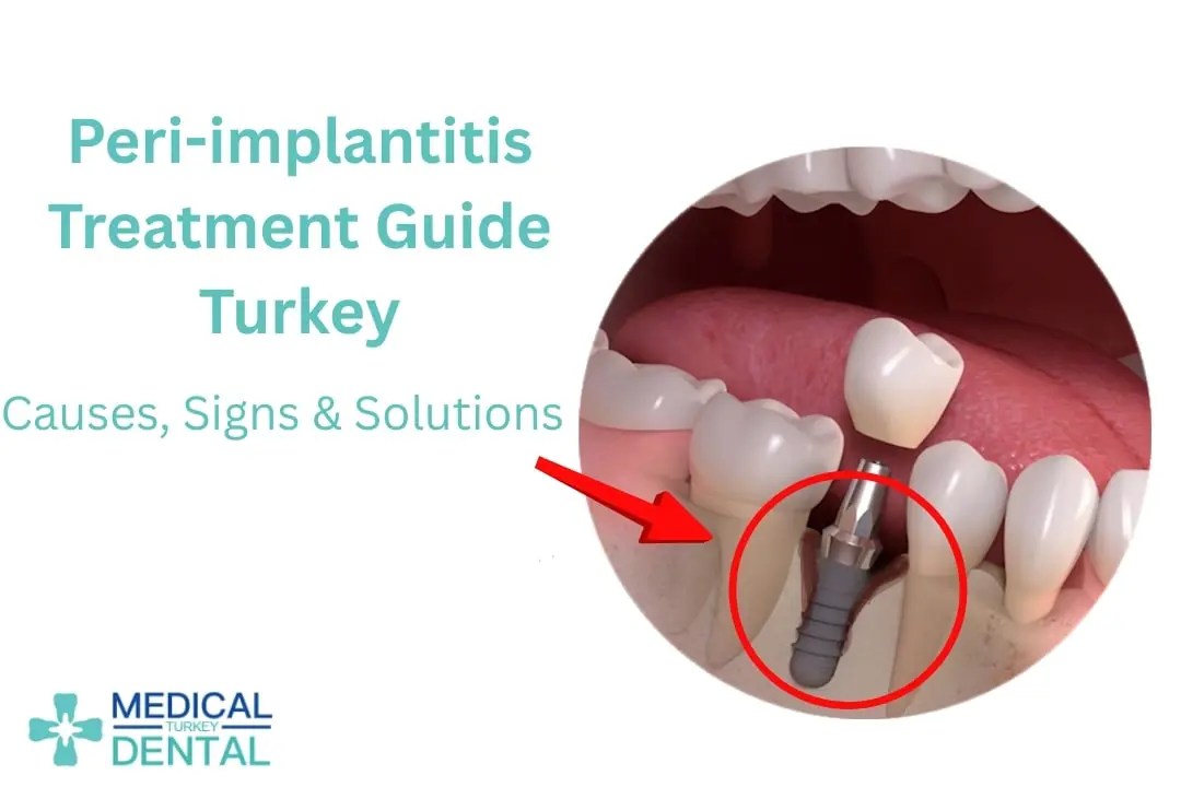 Peri-implantitis treatments Peri-implantitis Treatments
