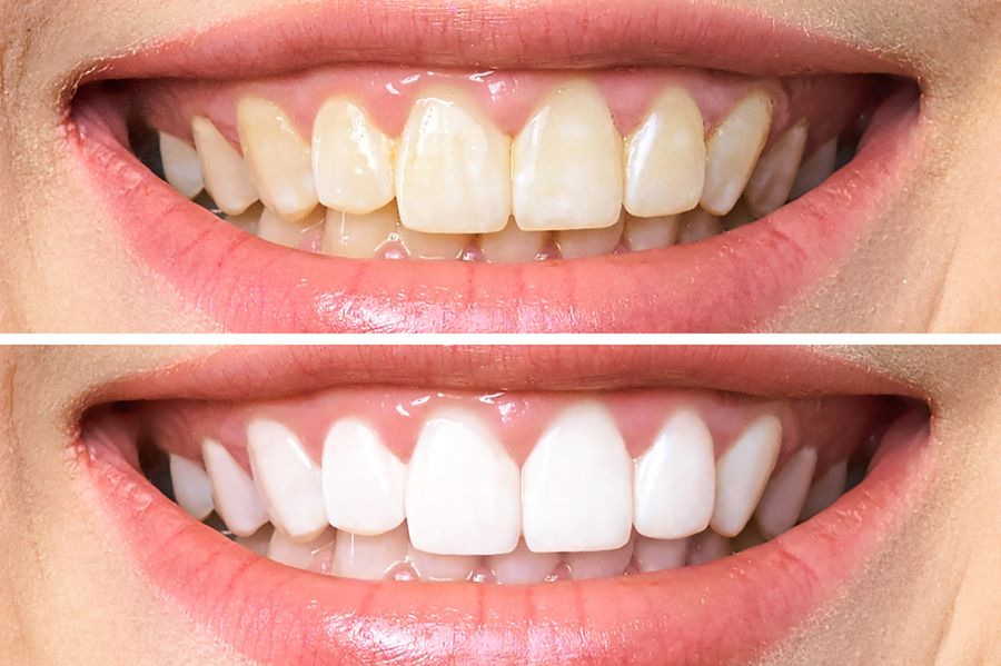 Teeth Whitening before after in Antalya, Turkey
