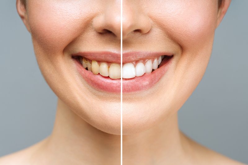 women teeths are diveded into 2 part one is white other is yellow