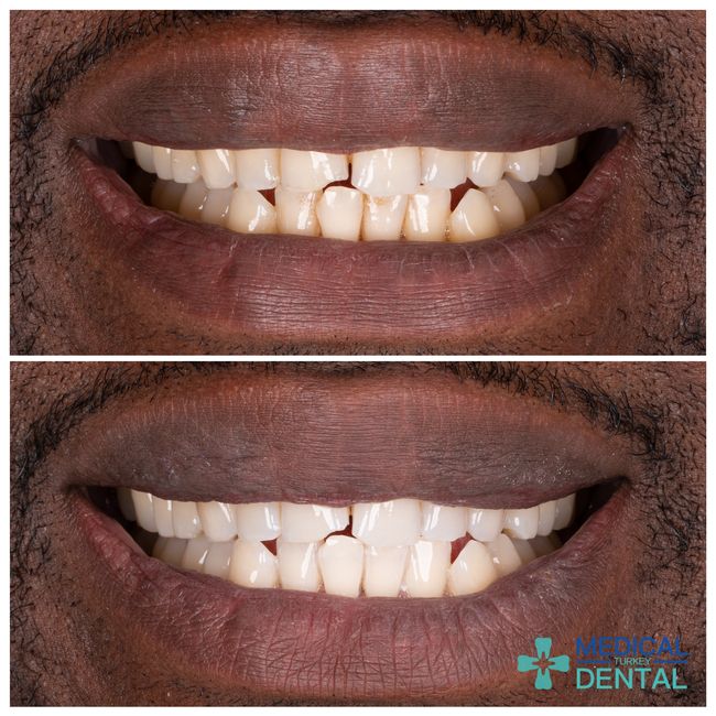 Teeth bleaching befora after in Turkey