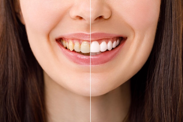 What causes tooth discoloration? What causes tooth discoloration? Dental clinic Antalya