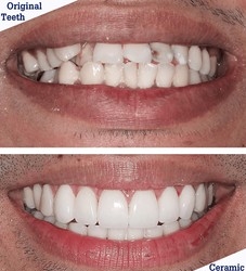Zirconium crowns before-after Zirconium-crowns before-after Antalya Turkey